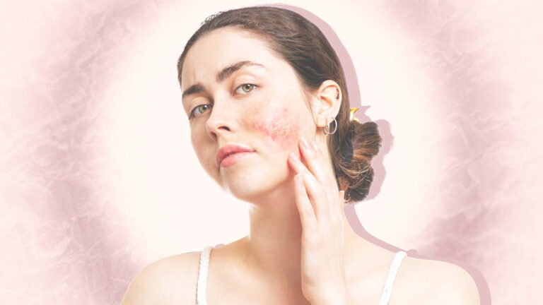Zdravie365.sk - Atopická dermatitída na tvári: Ako ju spoznať, liečiť a čo s ňou robiť